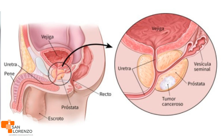 cancer-de-prostata